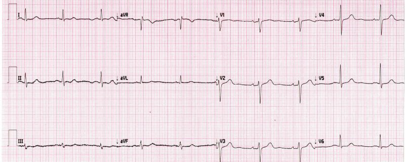 ECG