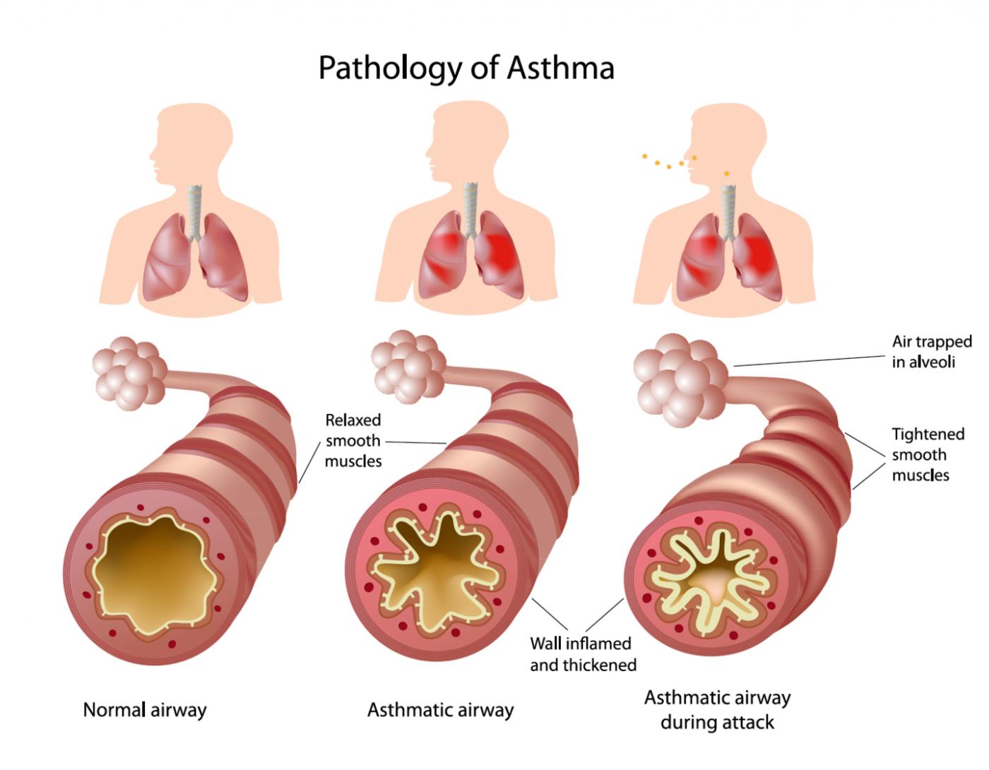 Pathology of asthma