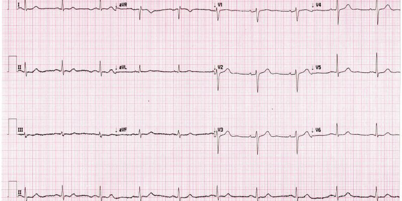 ECG
